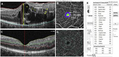 Hyperreflective Foci and Subretinal Fluid Are Potential Imaging Biomarkers to Evaluate Anti-VEGF Effect in Diabetic Macular Edema